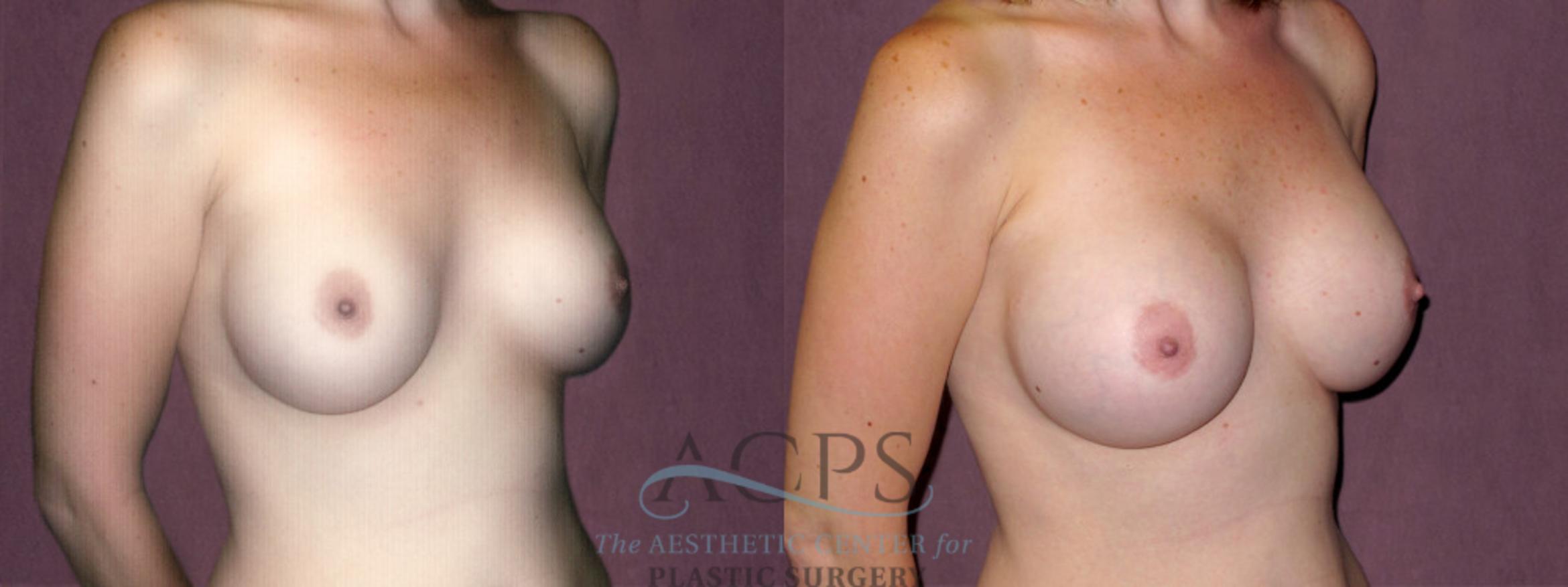 Before & After Breast Augmentation Case 919 Oblique Right View: View in Houston, TX