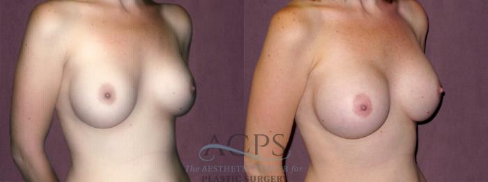 Before & After Breast Augmentation Case 919 Oblique Right View: View in Houston, TX
