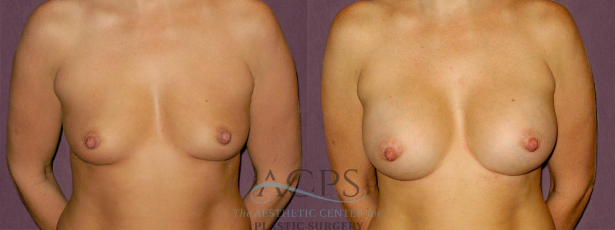 Before & After Breast Augmentation Case 920 Front View: View in Houston, TX