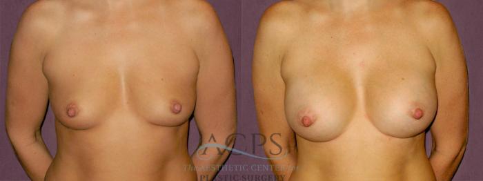 Before & After Breast Augmentation Case 920 Front View: View in Houston, TX