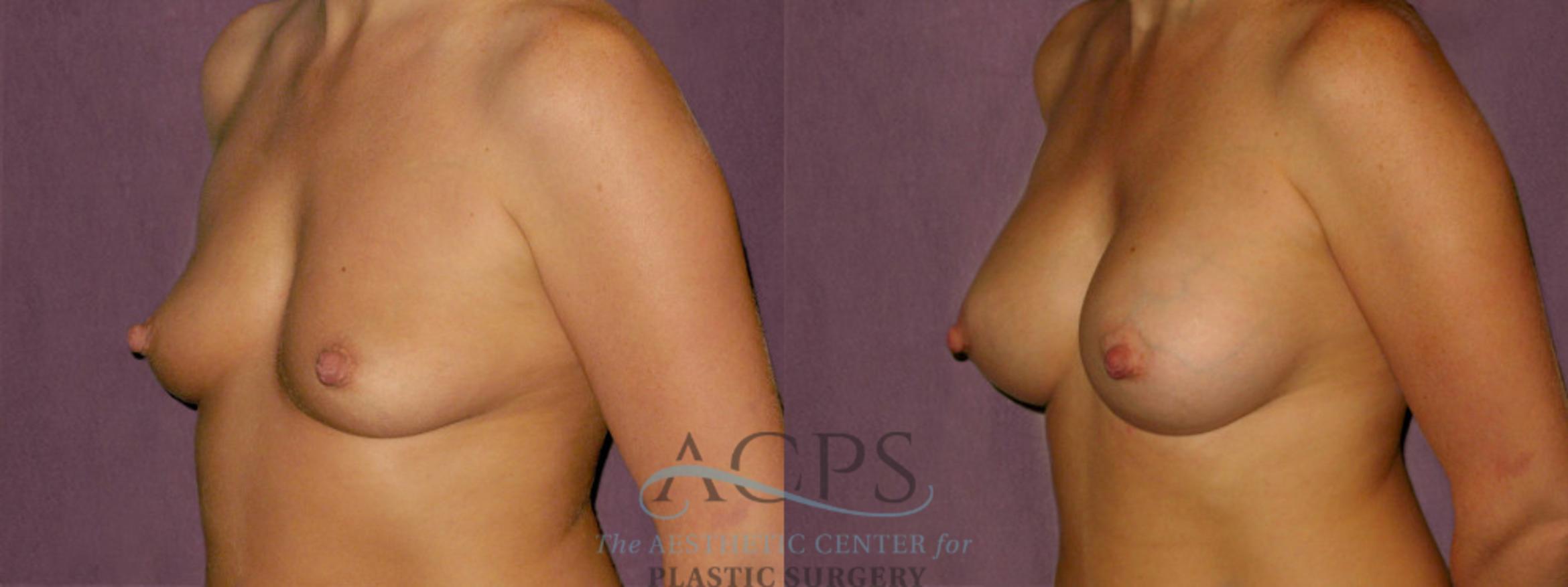 Before & After Breast Augmentation Case 920 Oblique Left View: View in Houston, TX