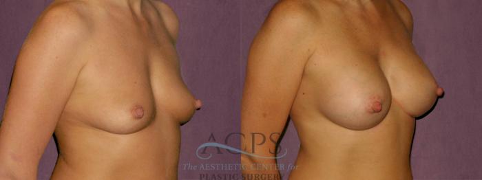 Before & After Breast Augmentation Case 920 Oblique Right View: View in Houston, TX