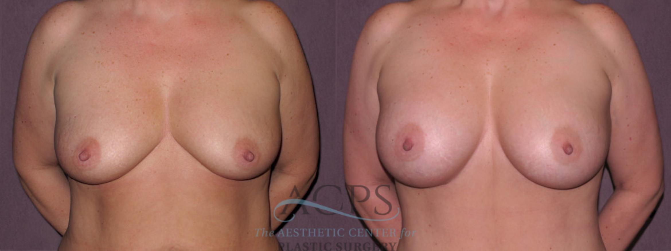 Before & After Breast Augmentation Case 921 Front View: View in Houston, TX