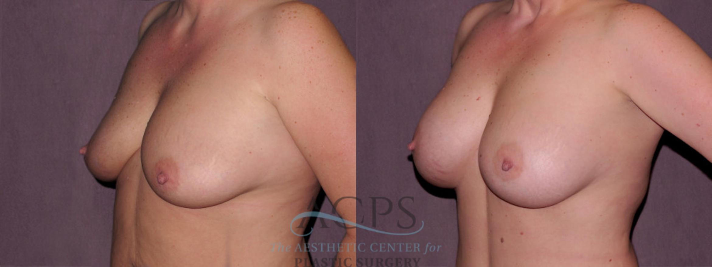 Before & After Breast Augmentation Case 921 Oblique Left View: View in Houston, TX