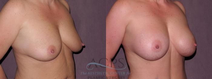 Before & After Breast Augmentation Case 921 Oblique Right View: View in Houston, TX