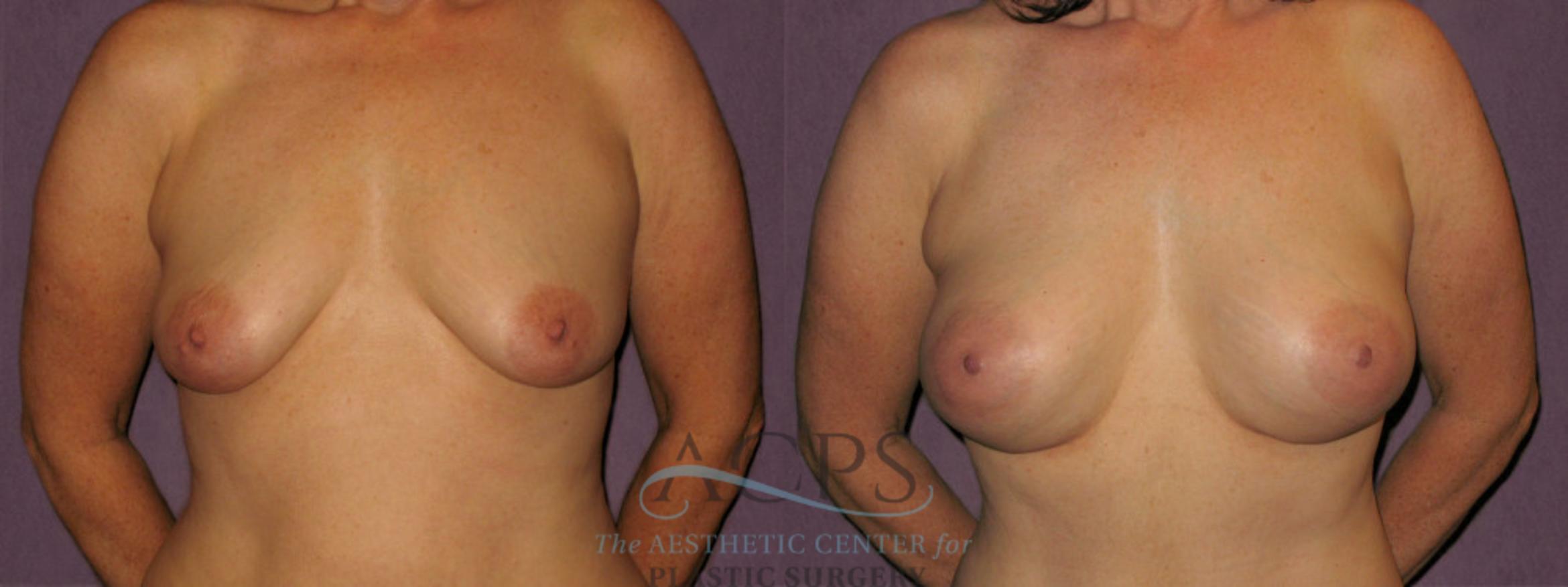 Before & After Breast Augmentation Case 922 Front View: View in Houston, TX