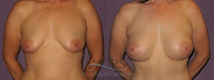Before & After Breast Augmentation Case 922 Front View: View in Houston, TX