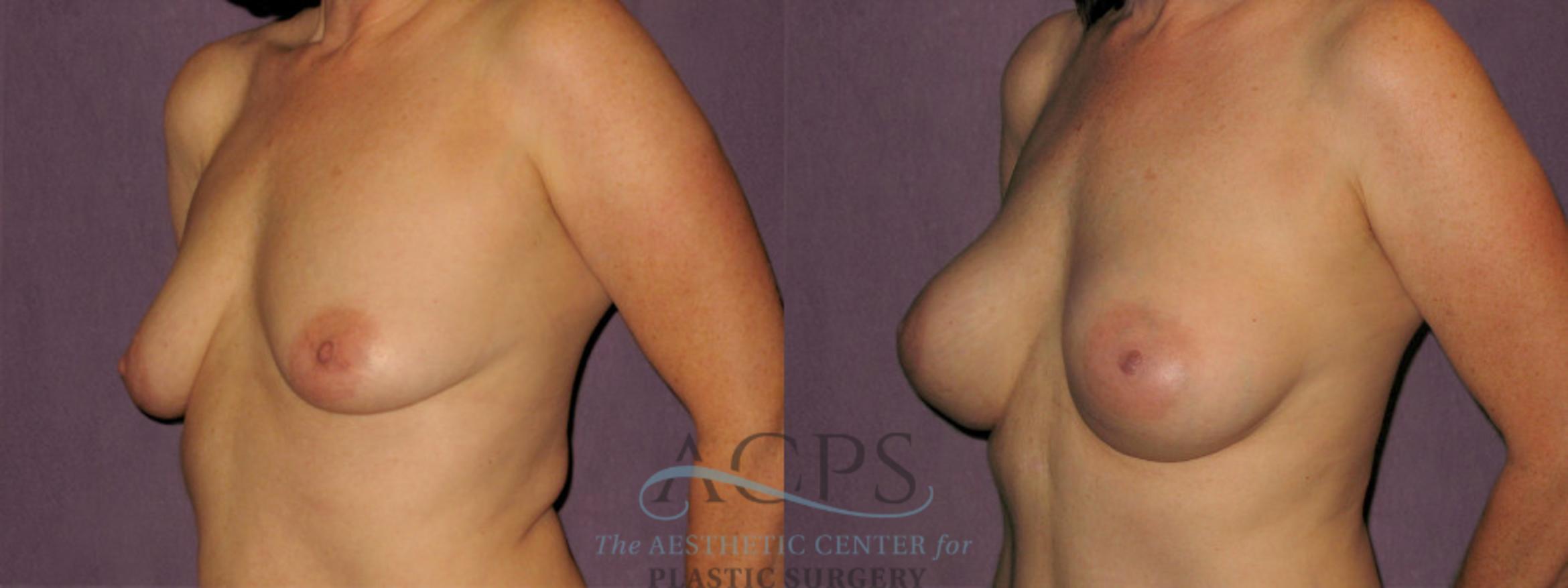 Before & After Breast Augmentation Case 922 Oblique Left View: View in Houston, TX