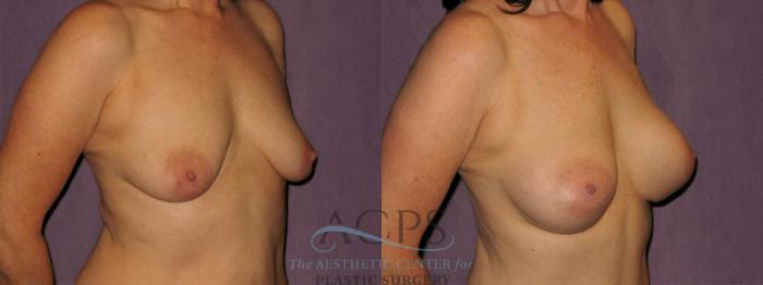 Before & After Breast Augmentation Case 922 Oblique Right View: View in Houston, TX