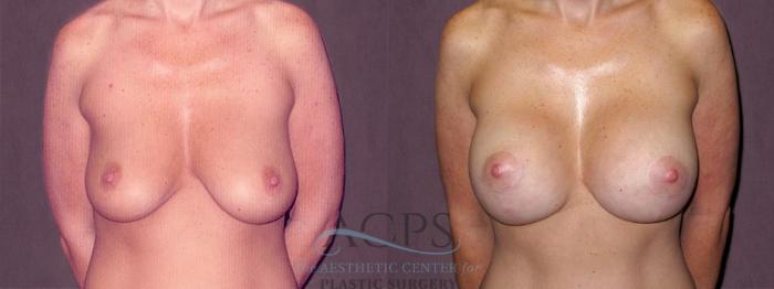 Before & After Breast Augmentation Case 923 Front View: View in Houston, TX