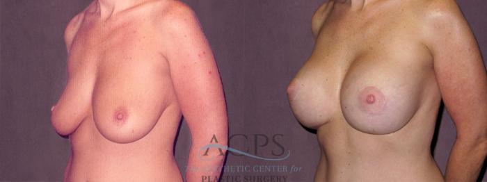 Before & After Breast Augmentation Case 923 Oblique Left View: View in Houston, TX
