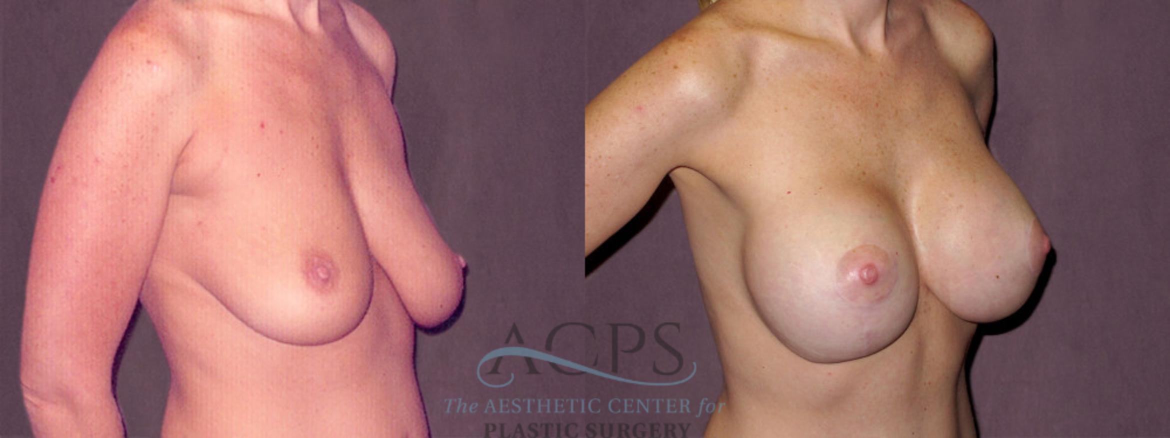Before & After Breast Augmentation Case 923 Oblique Right View: View in Houston, TX