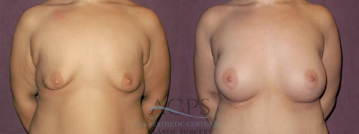 Before & After Breast Augmentation Case 924 Front View: View in Houston, TX