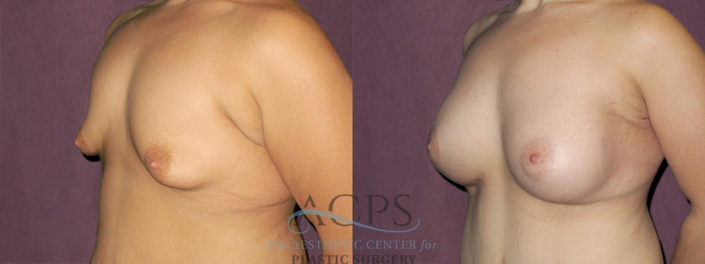 Before & After Breast Augmentation Case 924 Oblique Left View: View in Houston, TX