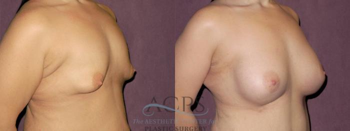 Before & After Breast Augmentation Case 924 Oblique Right View: View in Houston, TX