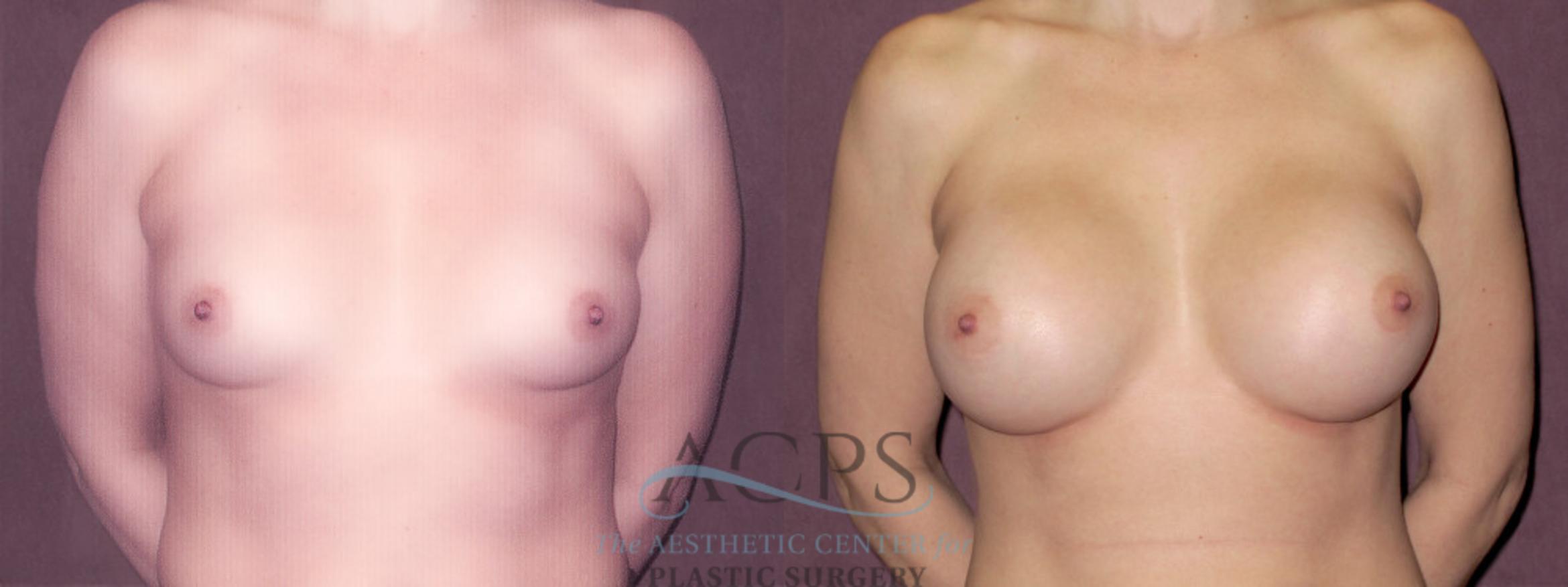 Before & After Breast Augmentation Case 925 Front View: View in Houston, TX