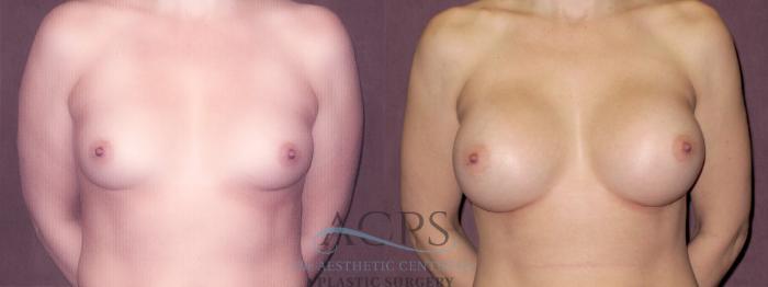 Before & After Breast Augmentation Case 925 Front View: View in Houston, TX