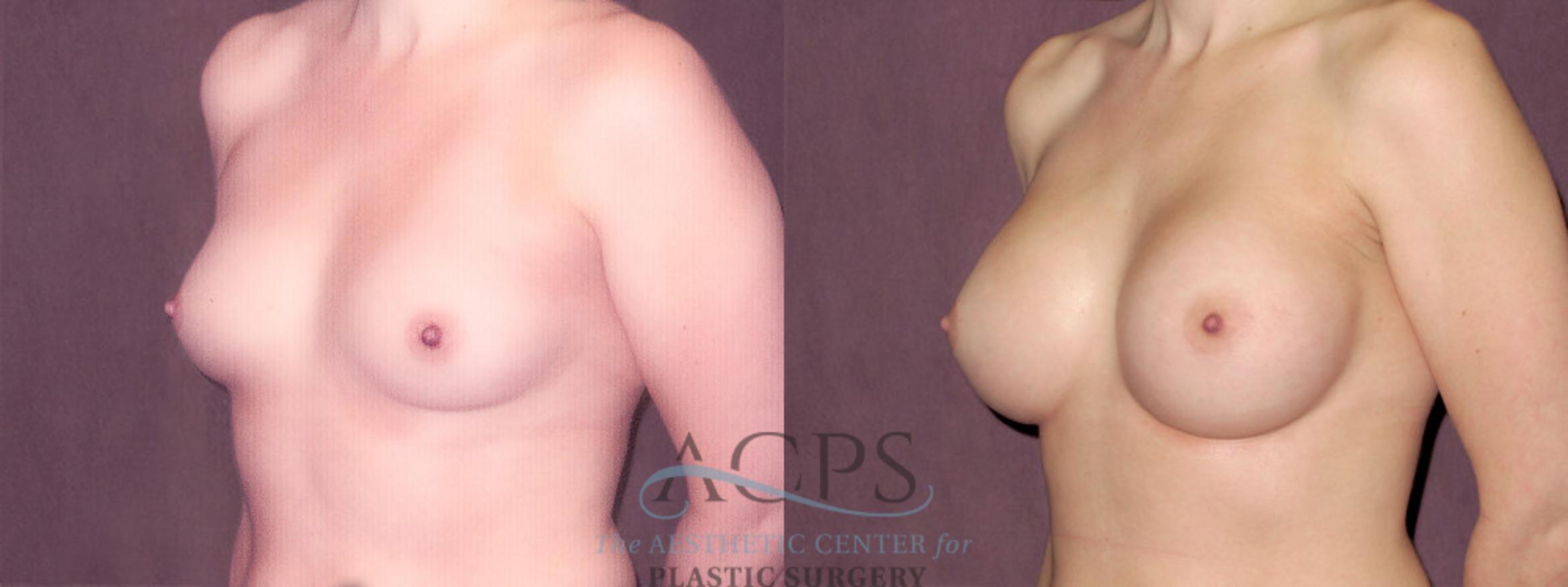 Before & After Breast Augmentation Case 925 Oblique Left View: View in Houston, TX