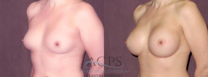 Before & After Breast Augmentation Case 925 Oblique Left View: View in Houston, TX