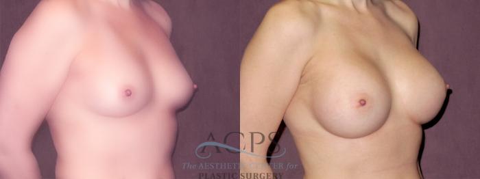 Before & After Breast Augmentation Case 925 Oblique Right View: View in Houston, TX