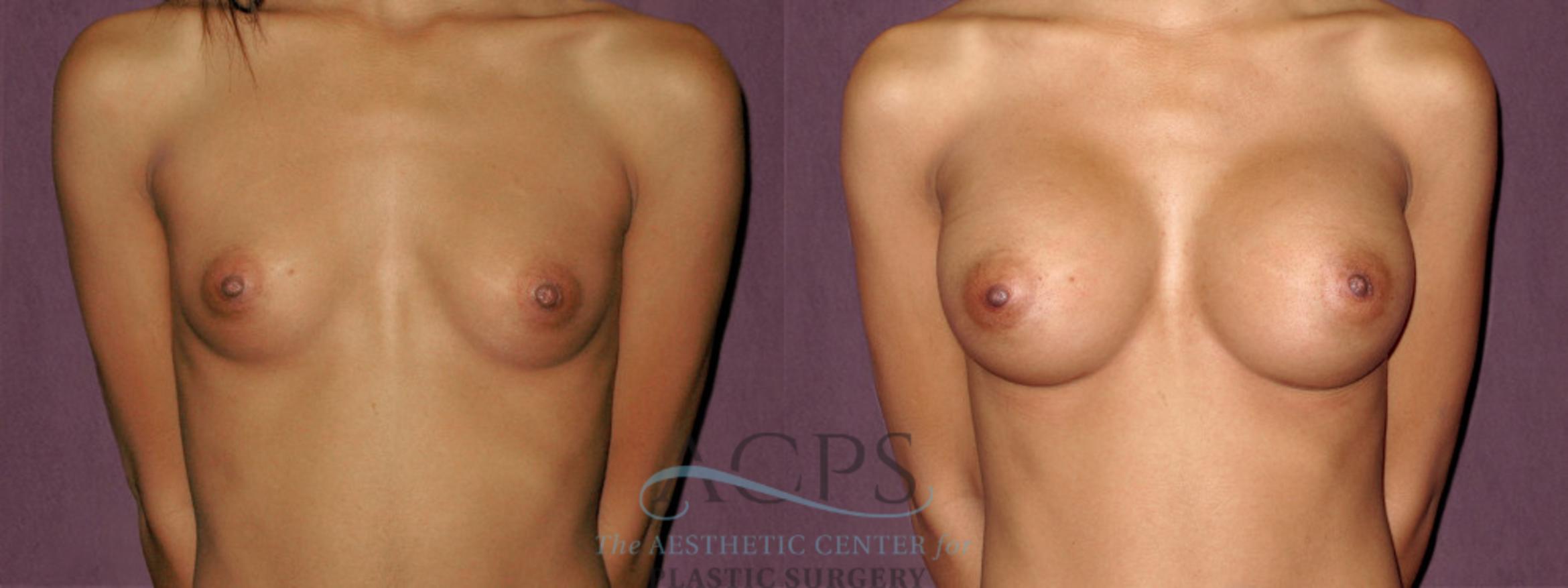 Before & After Breast Augmentation Case 926 Front View: View in Houston, TX