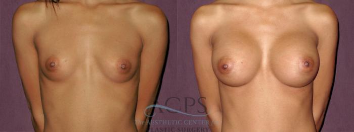 Before & After Breast Augmentation Case 926 Front View: View in Houston, TX