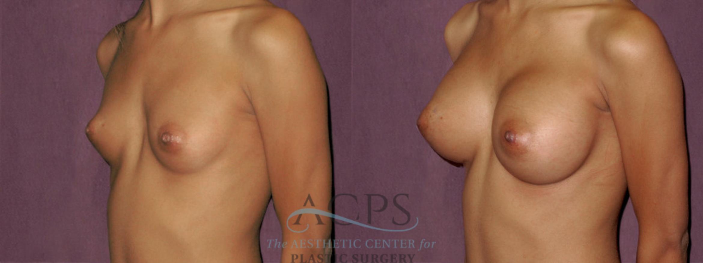 Before & After Breast Augmentation Case 926 Oblique Left View: View in Houston, TX