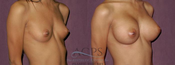 Before & After Breast Augmentation Case 926 Oblique Right View: View in Houston, TX