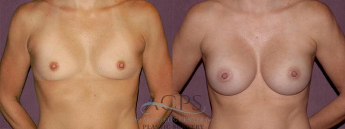 Before & After Breast Augmentation Case 927 Front View: View in Houston, TX