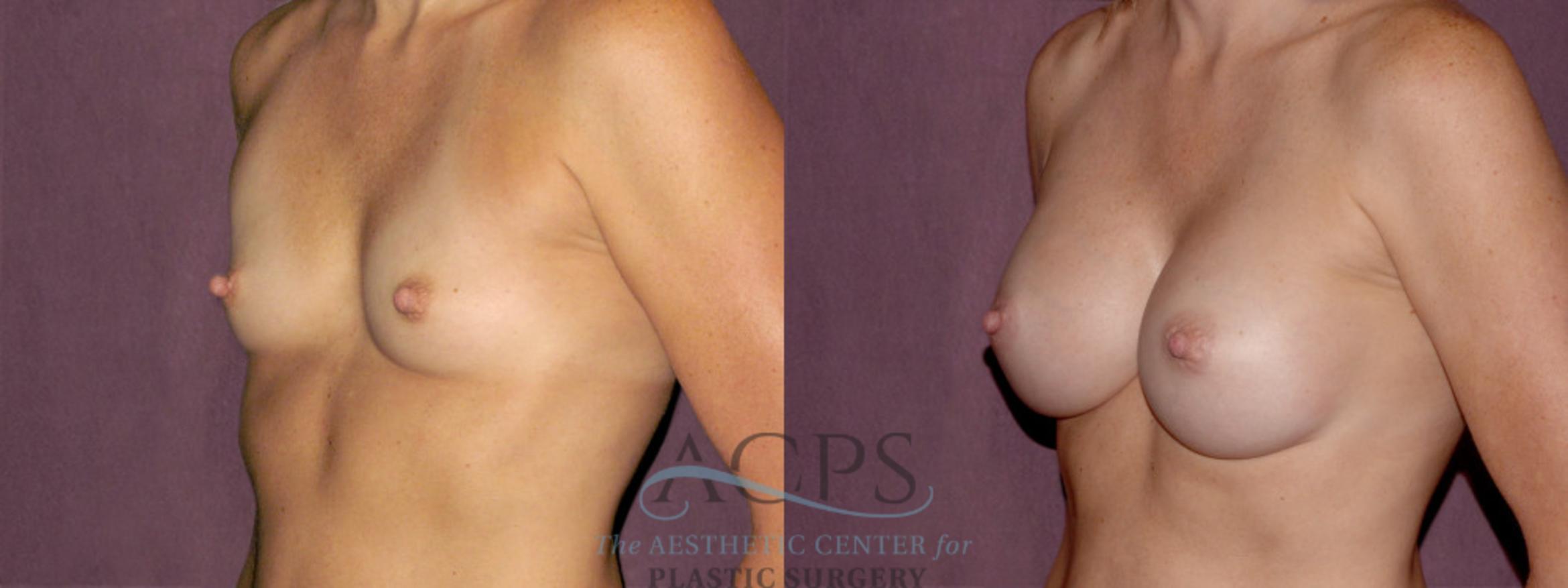 Before & After Breast Augmentation Case 927 Oblique Left View: View in Houston, TX