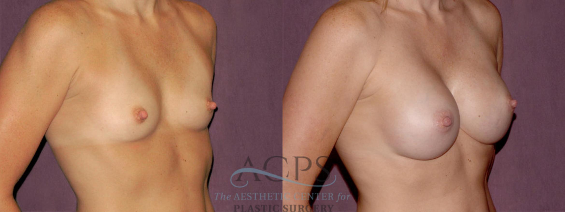 Before & After Breast Augmentation Case 927 Oblique Right View: View in Houston, TX