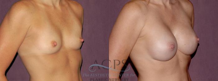 Before & After Breast Augmentation Case 927 Oblique Right View: View in Houston, TX