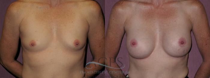 Before & After Breast Augmentation Case 928 Front View: View in Houston, TX