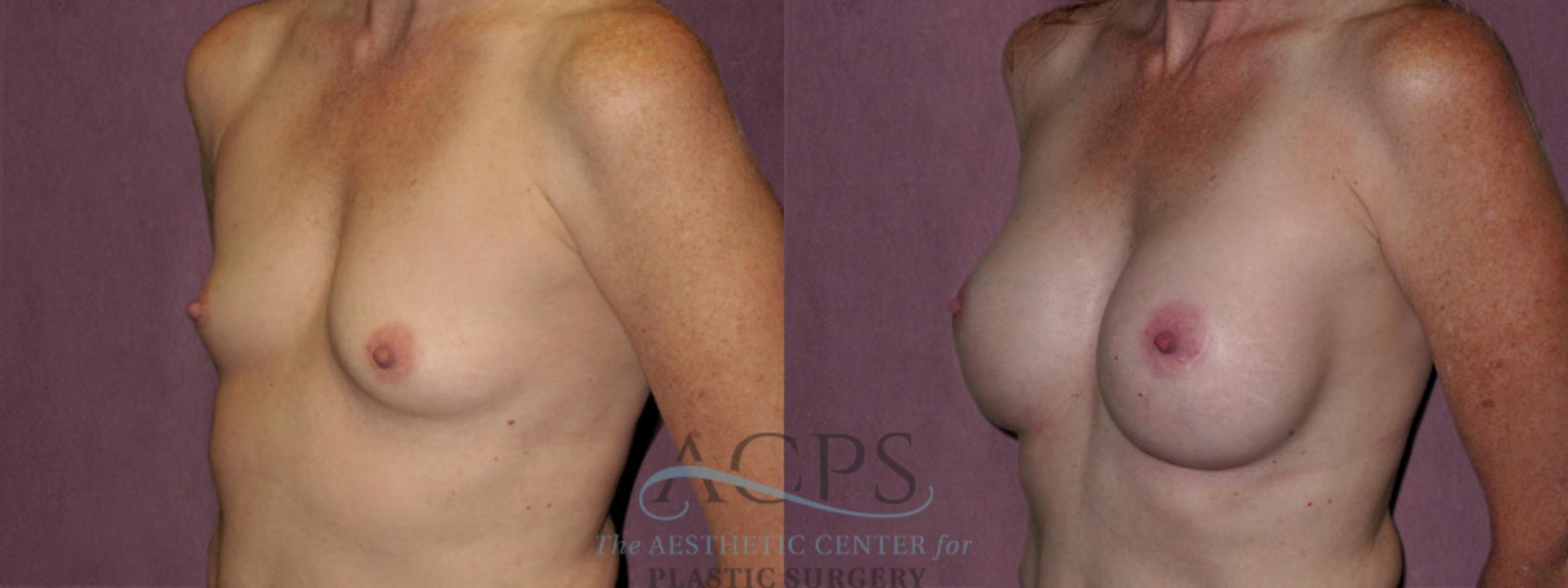Before & After Breast Augmentation Case 928 Oblique Left View: View in Houston, TX