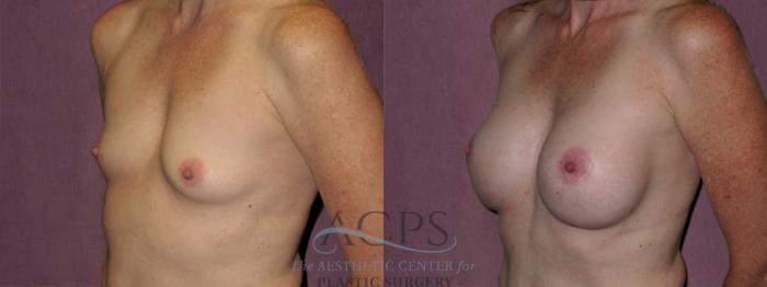 Before & After Breast Augmentation Case 928 Oblique Left View: View in Houston, TX