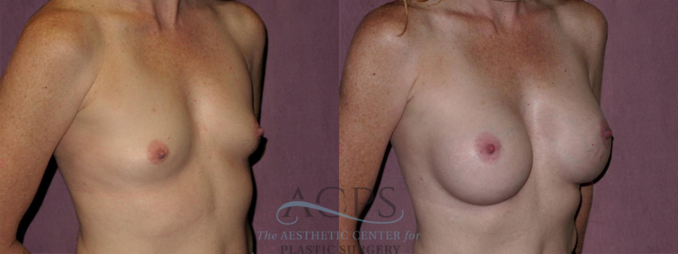 Before & After Breast Augmentation Case 928 Oblique Right View: View in Houston, TX