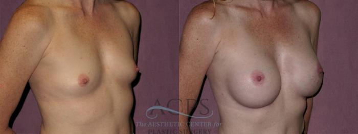 Before & After Breast Augmentation Case 928 Oblique Right View: View in Houston, TX