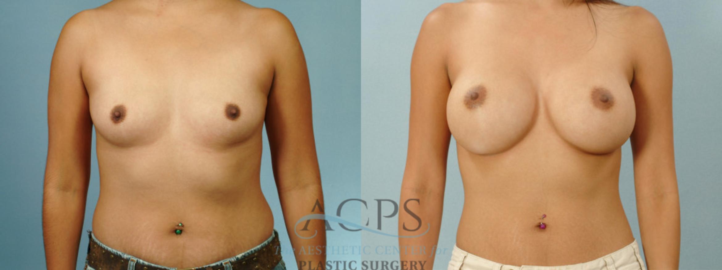 Before & After Breast Augmentation Case 929 Front View: View in Houston, TX