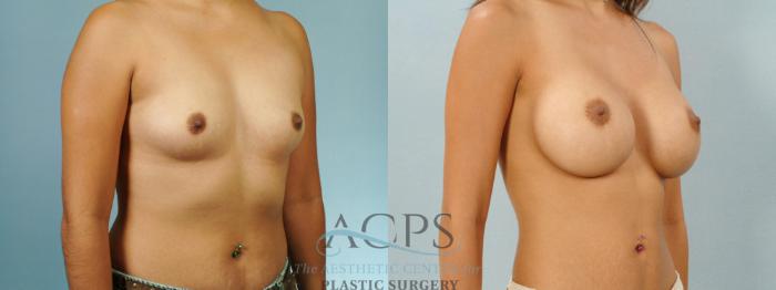 Before & After Breast Augmentation Case 929 Oblique View: View in Houston, TX