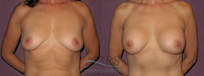 Before & After Breast Augmentation Case 930 Front View: View in Houston, TX