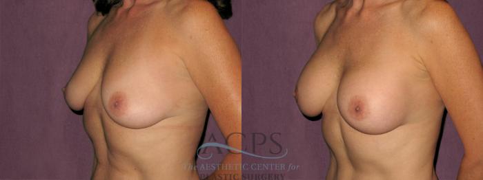 Before & After Breast Augmentation Case 930 Oblique Left View: View in Houston, TX