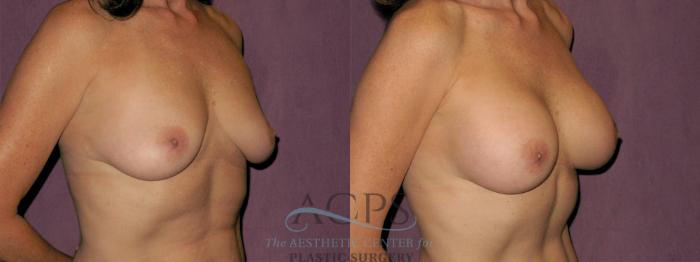 Before & After Breast Augmentation Case 930 Oblique Right View: View in Houston, TX