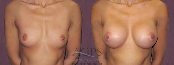 Before & After Breast Augmentation Case 931 Front View: View in Houston, TX
