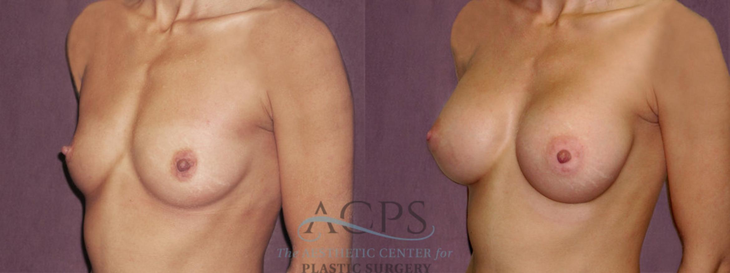 Before & After Breast Augmentation Case 931 Oblique Left View: View in Houston, TX