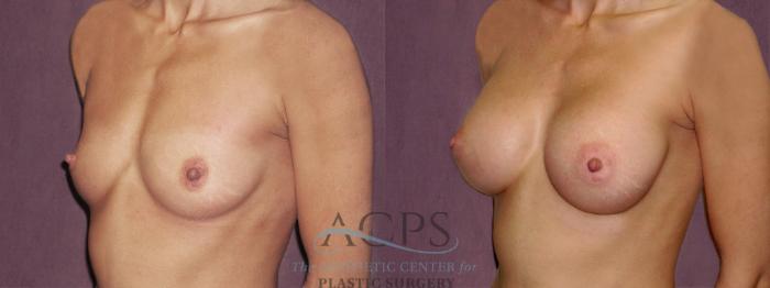 Before & After Breast Augmentation Case 931 Oblique Left View: View in Houston, TX