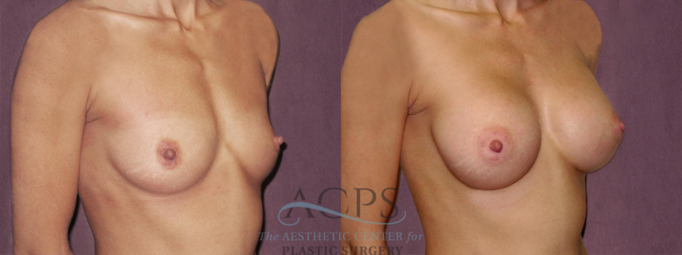 Before & After Breast Augmentation Case 931 Oblique Right View: View in Houston, TX