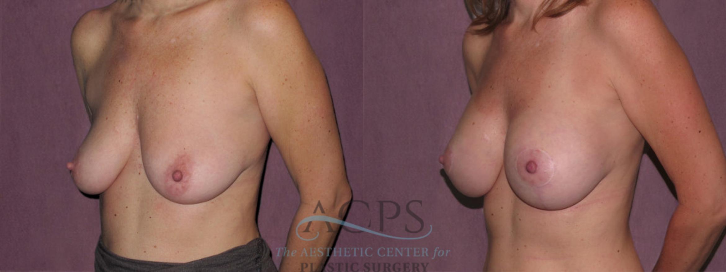 Before & After Breast Augmentation Case 932 Oblique Left View: View in Houston, TX