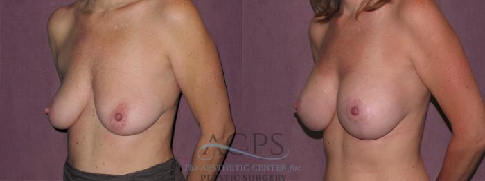 Before & After Breast Augmentation Case 932 Oblique Left View: View in Houston, TX