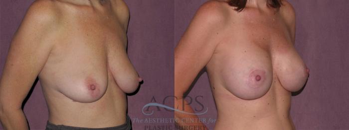 Before & After Breast Augmentation Case 932 Oblique Right View: View in Houston, TX