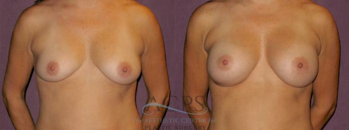 Before & After Breast Augmentation Case 933 Front View: View in Houston, TX
